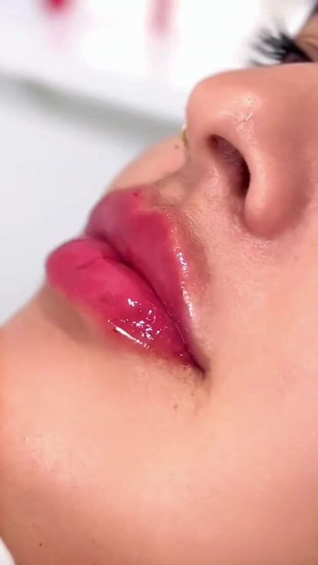 Quanto tempo dura o preenchimento labial?