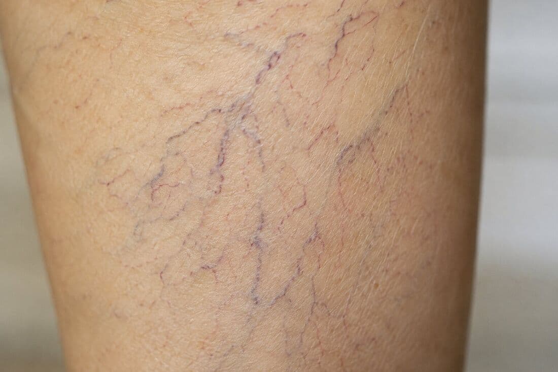 Tratamento de Vasinhos (Escleroterapia) no Guarujá, Dra. Fernanda Paz
