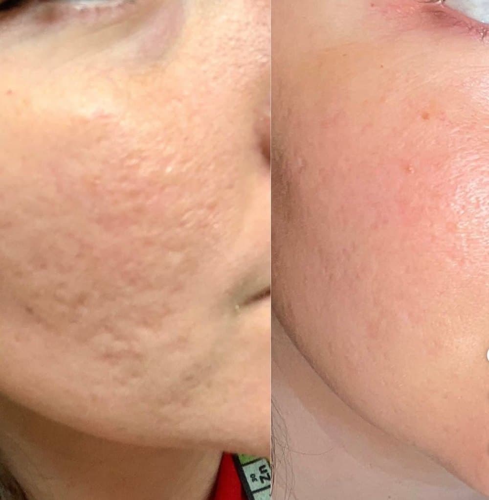 Antes e depois: Cicatrizes de acne