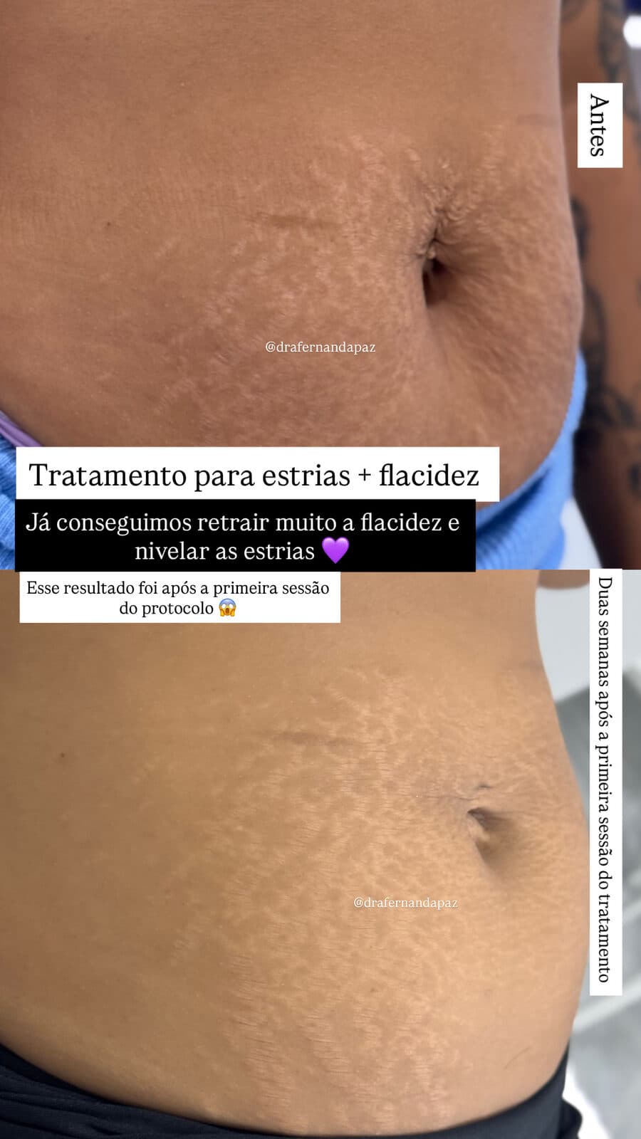 Tratamento de Flacidez no Guarujá, Dra. Fernanda Paz