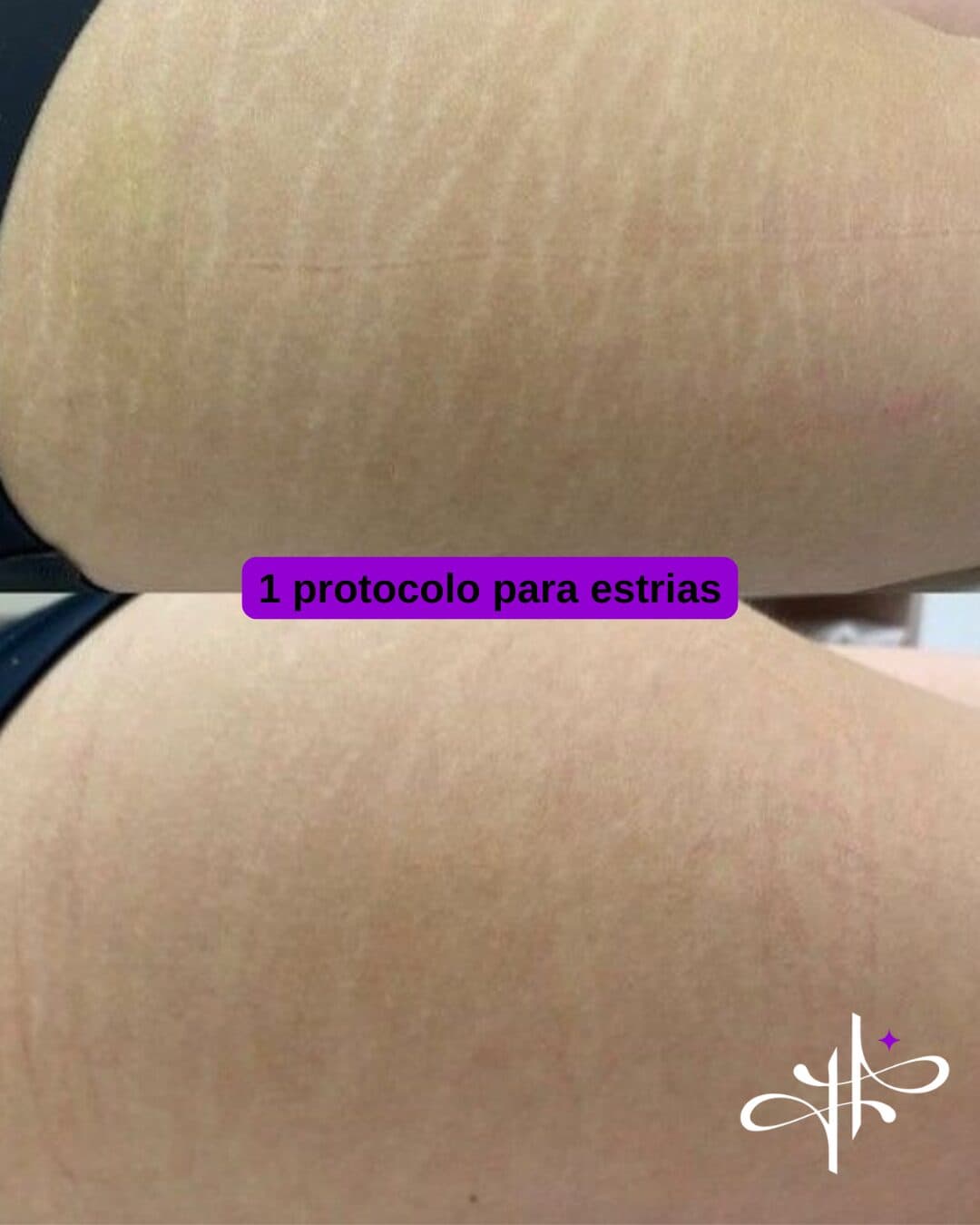 Antes e depois: Estrias