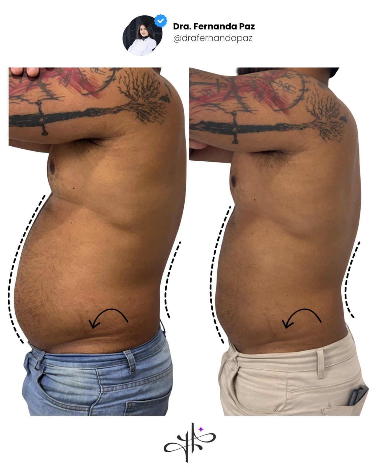 Antes e depois: Lipo enzimática