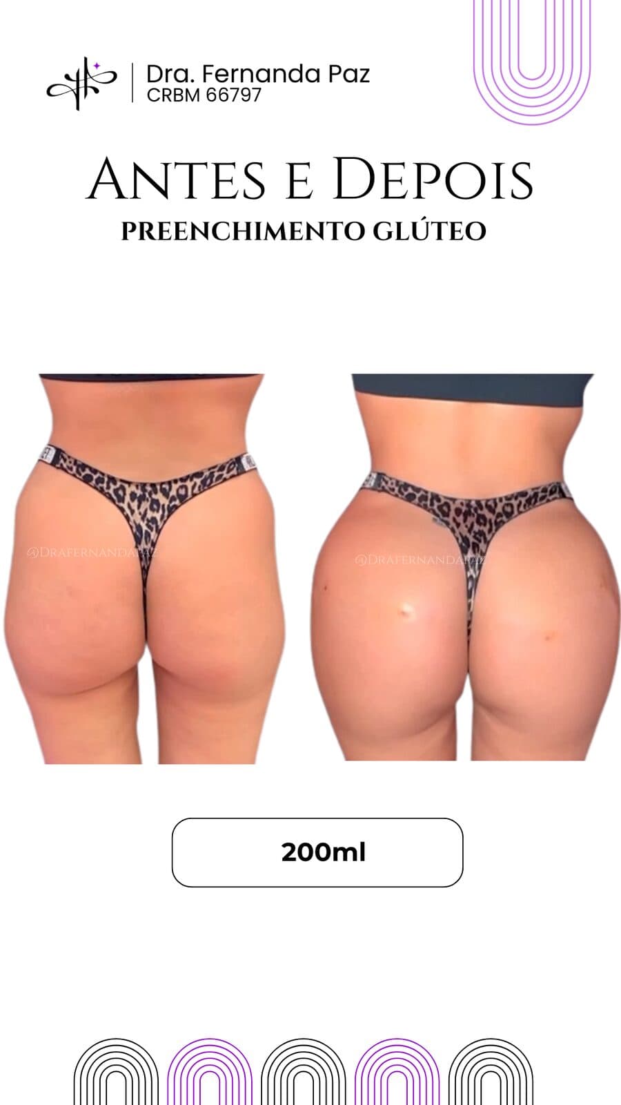Antes e depois: Preenchimento de glúteo