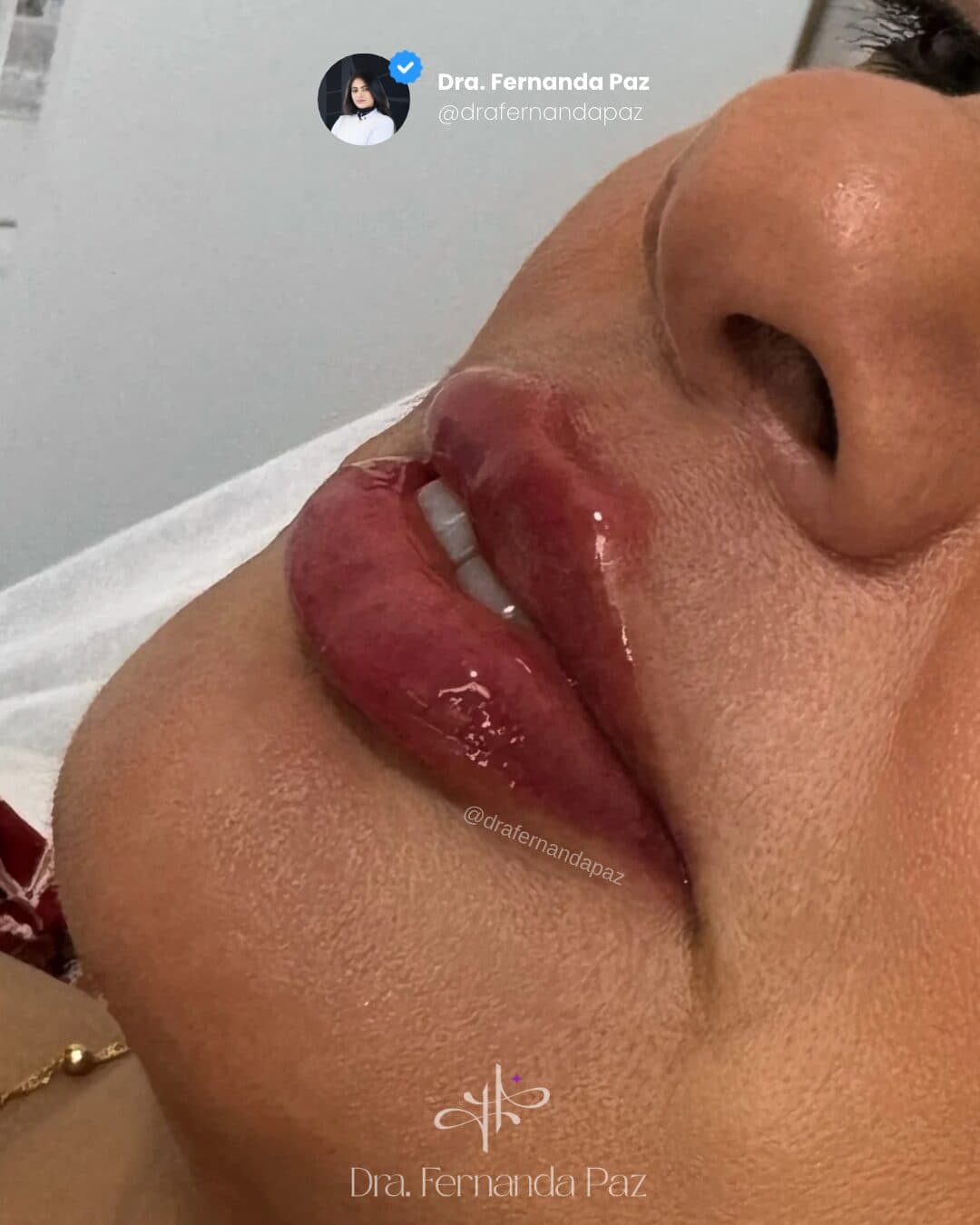 Depois: Preenchimento labial