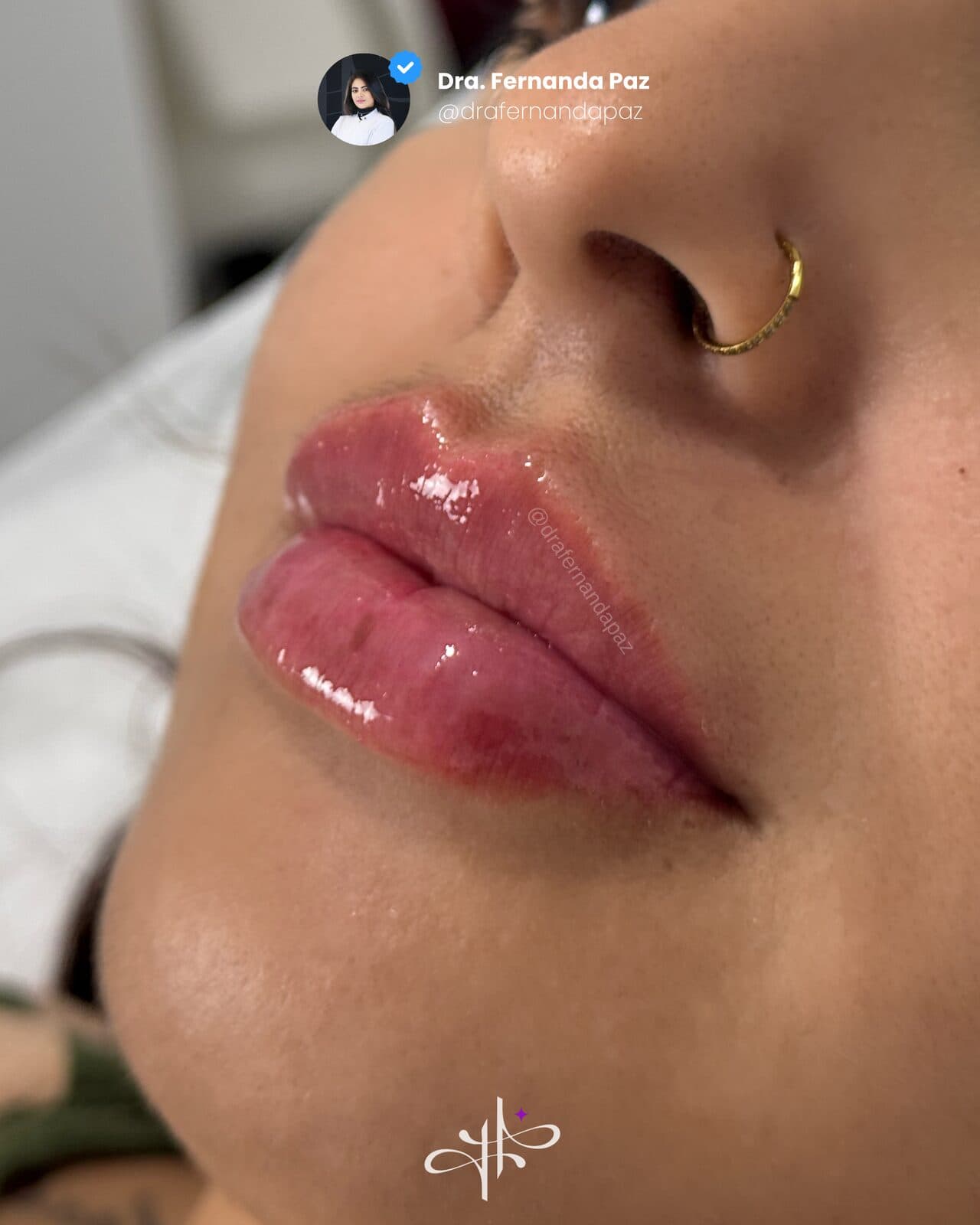 Depois: Preenchimento labial