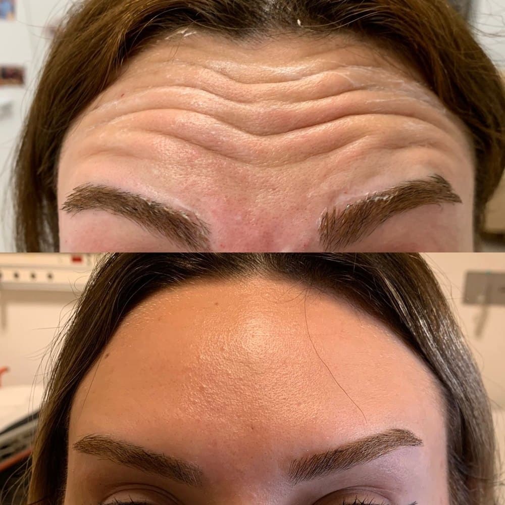 Antes e depois: Toxina botulínica