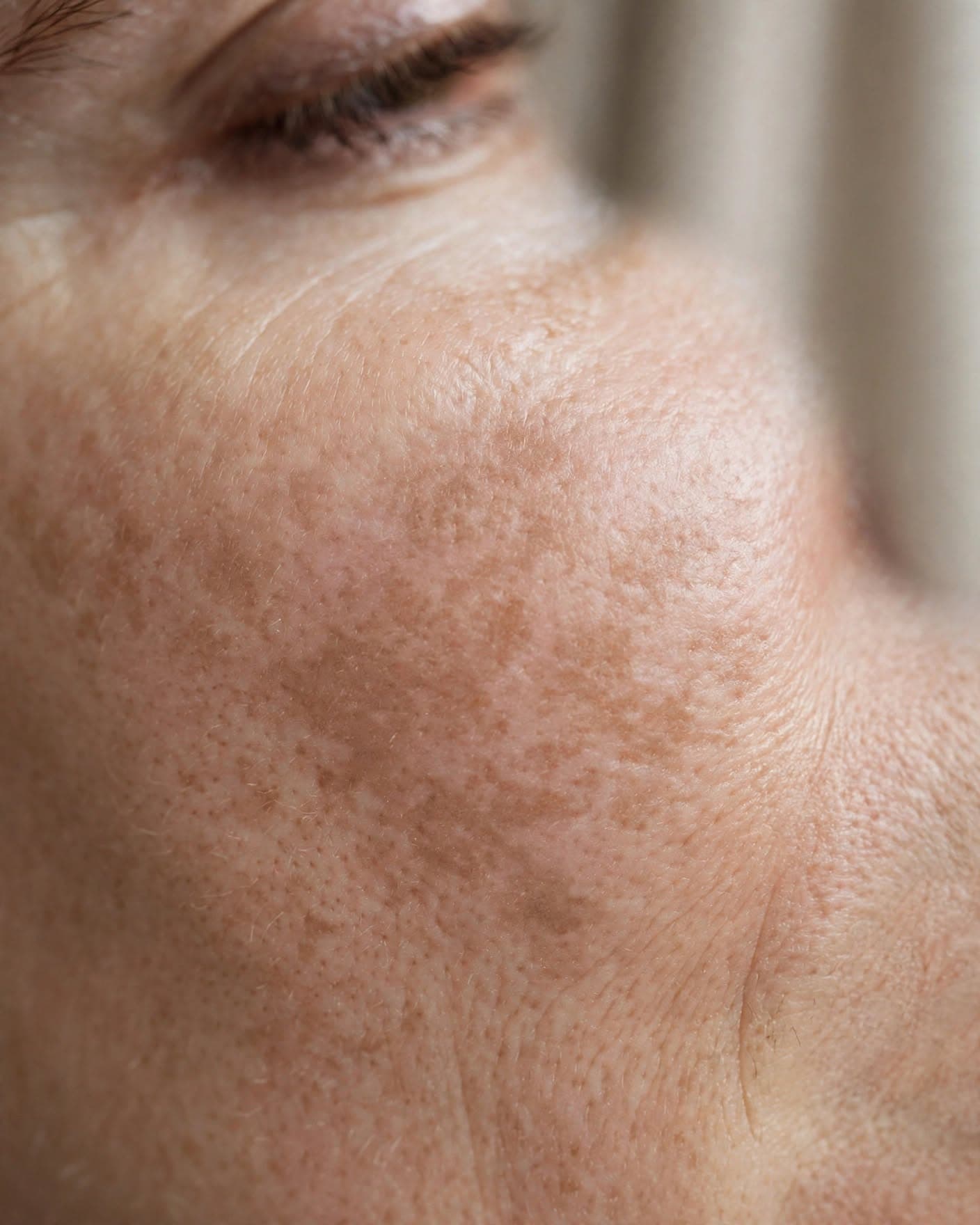 Melasma: manchas causadas por ativação do melanócito