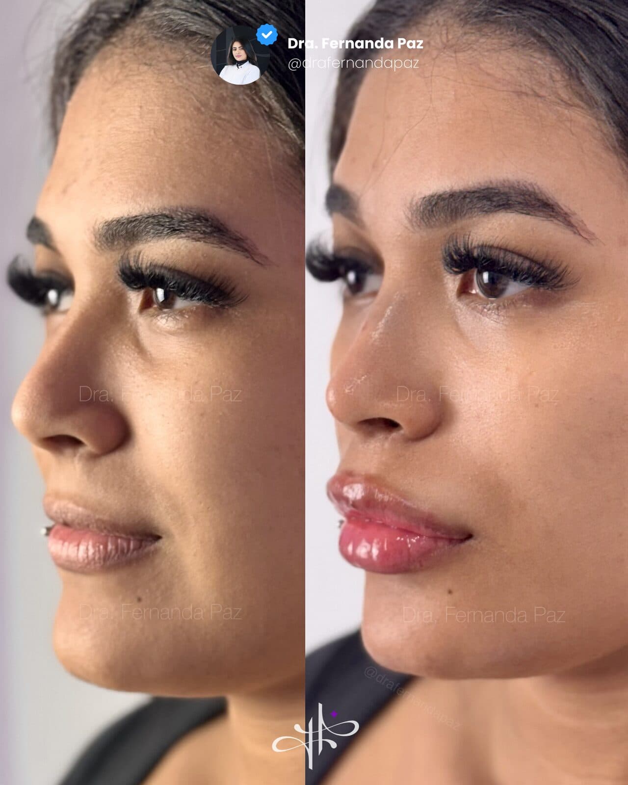 Antes e depois: Perfiloplastia