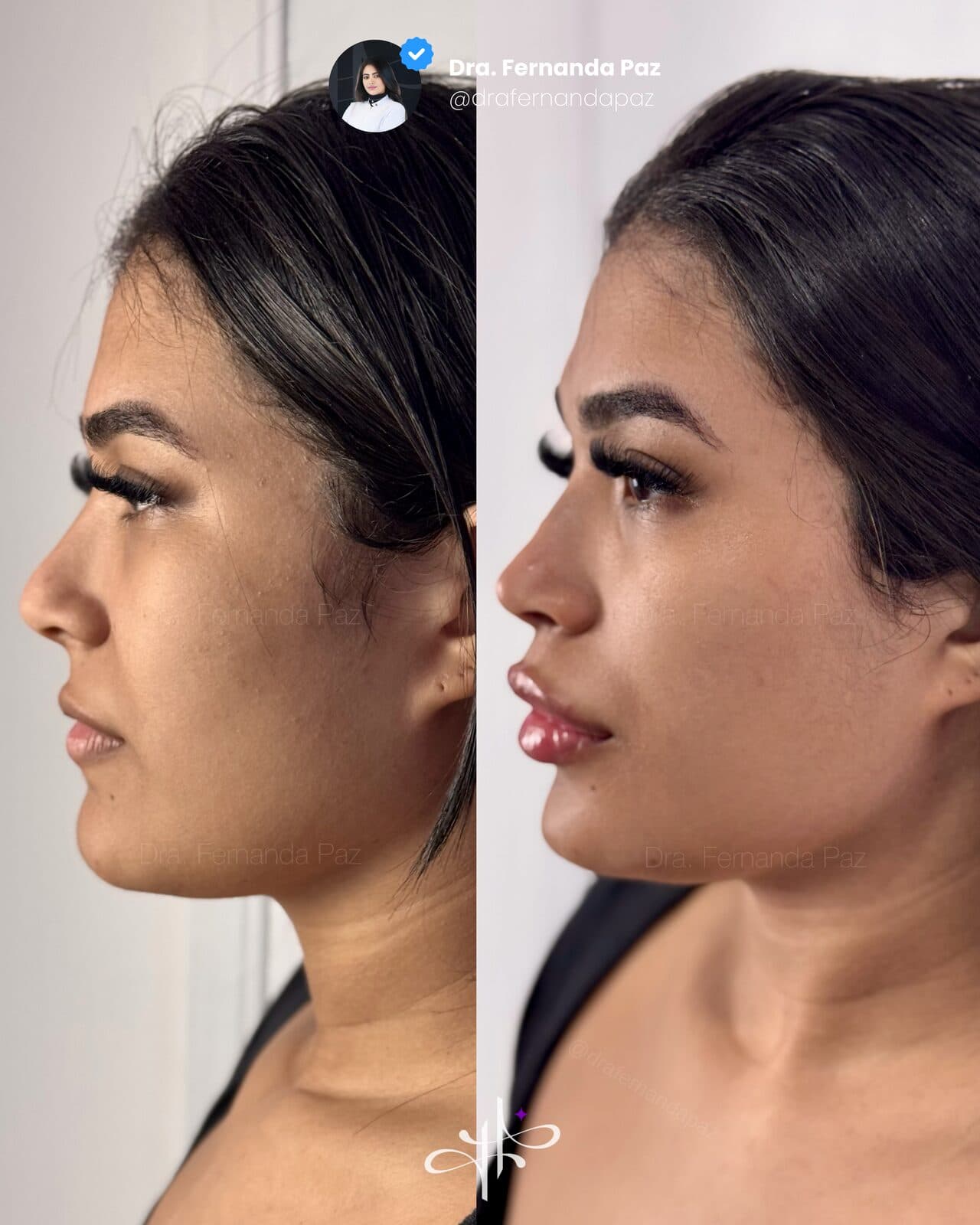Antes e depois: Harmonização facial