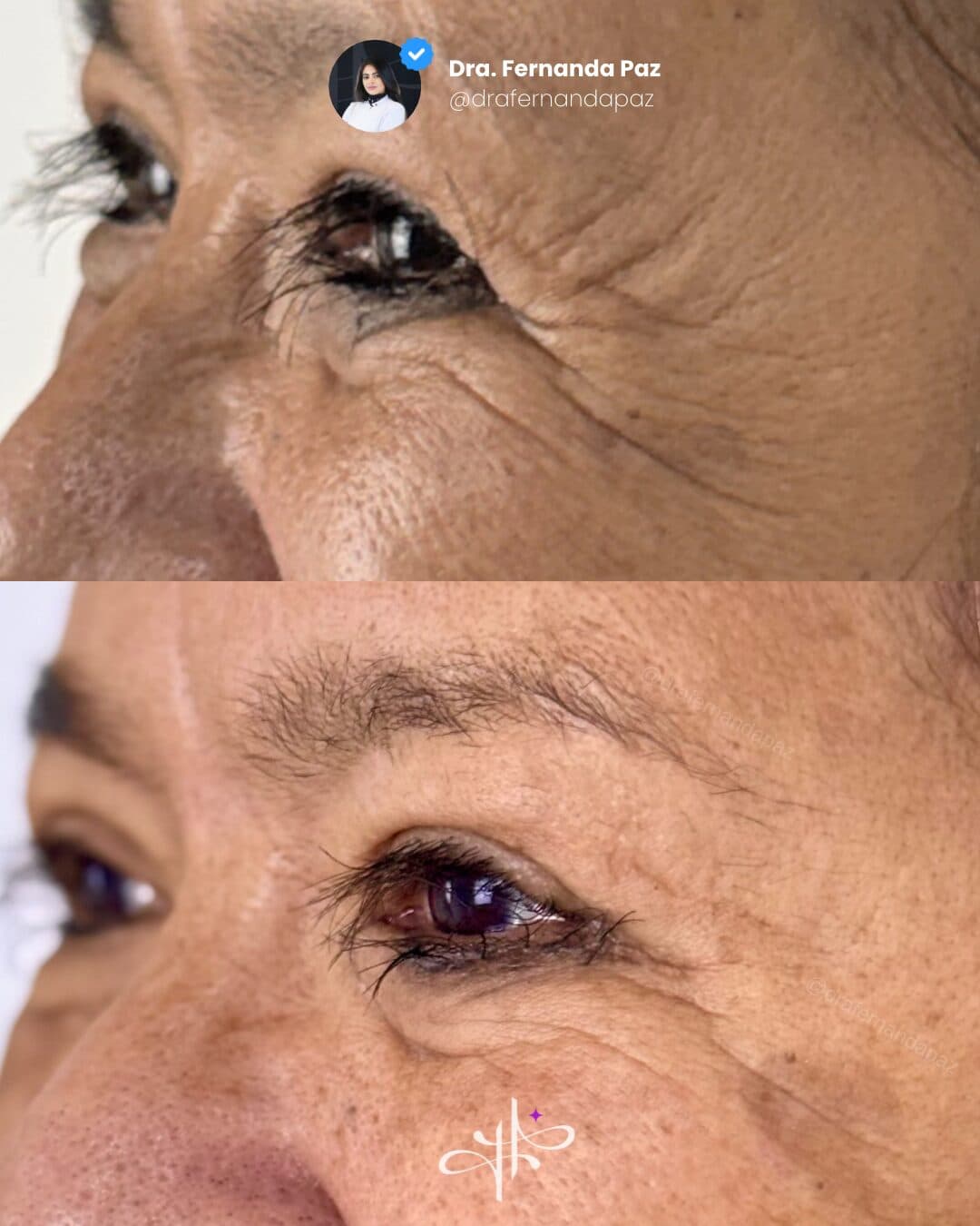 Antes e depois: Toxina botulínica