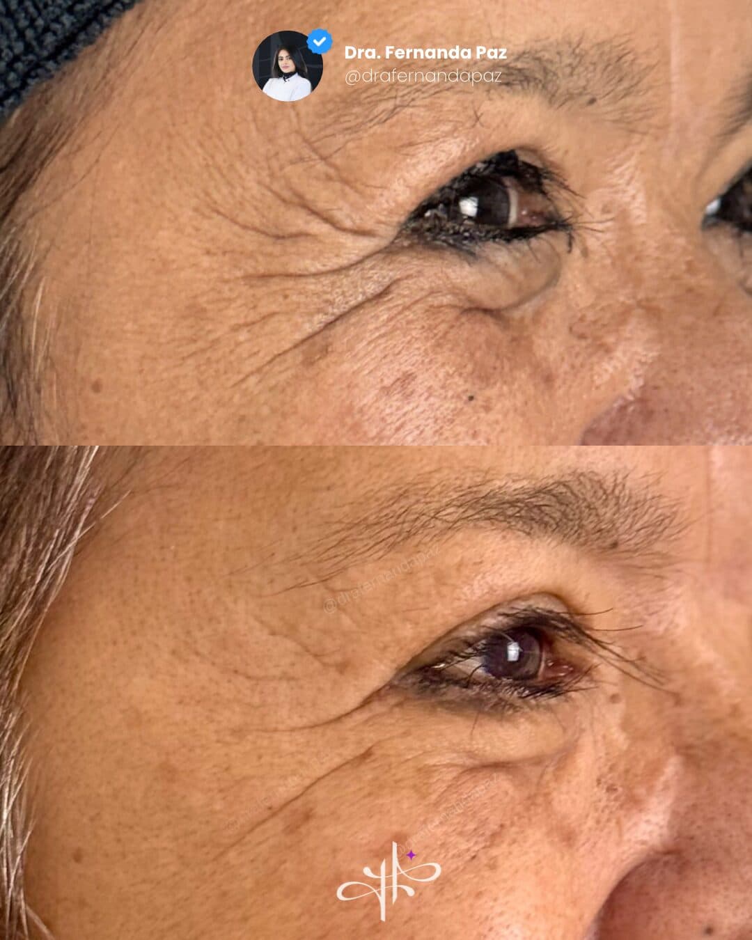 Antes e depois: Toxina botulínica com fios de PDO